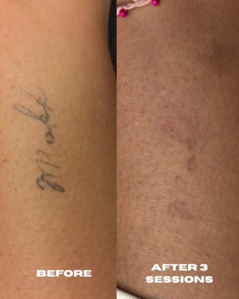 Before and after tattoo fading following three sessions, from Mrakki’s existing gallery