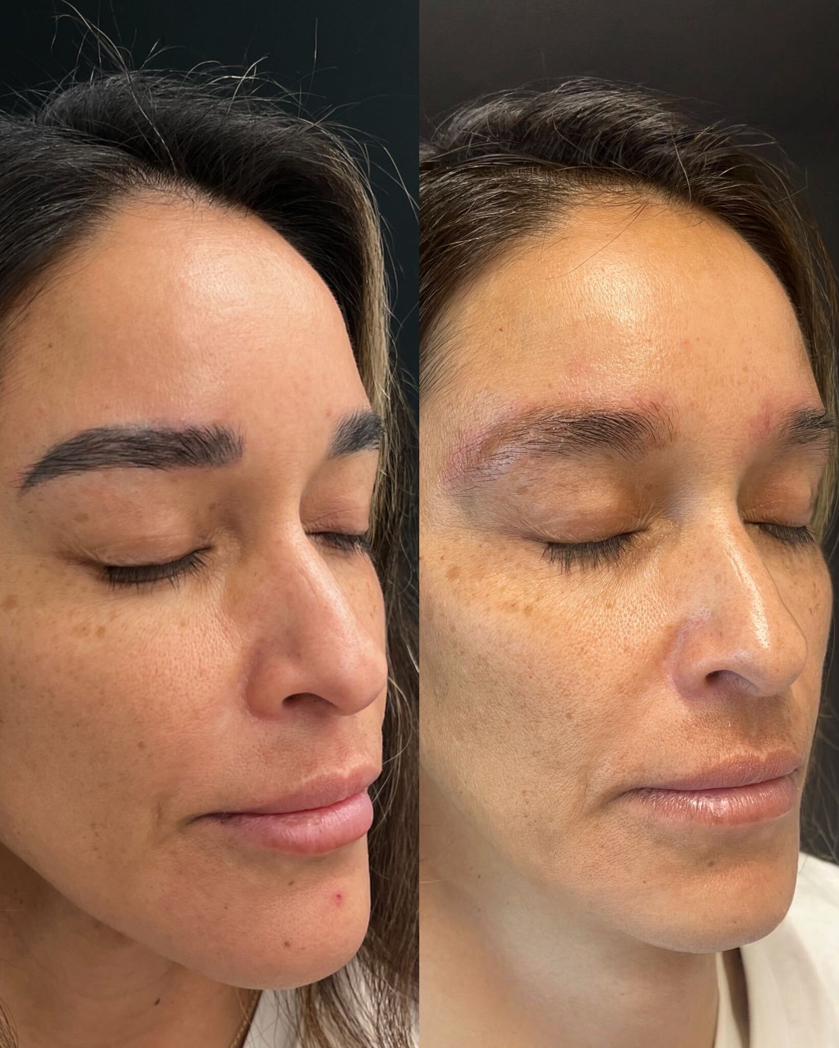 Side-by-side comparison of brow pigment during microblading removal