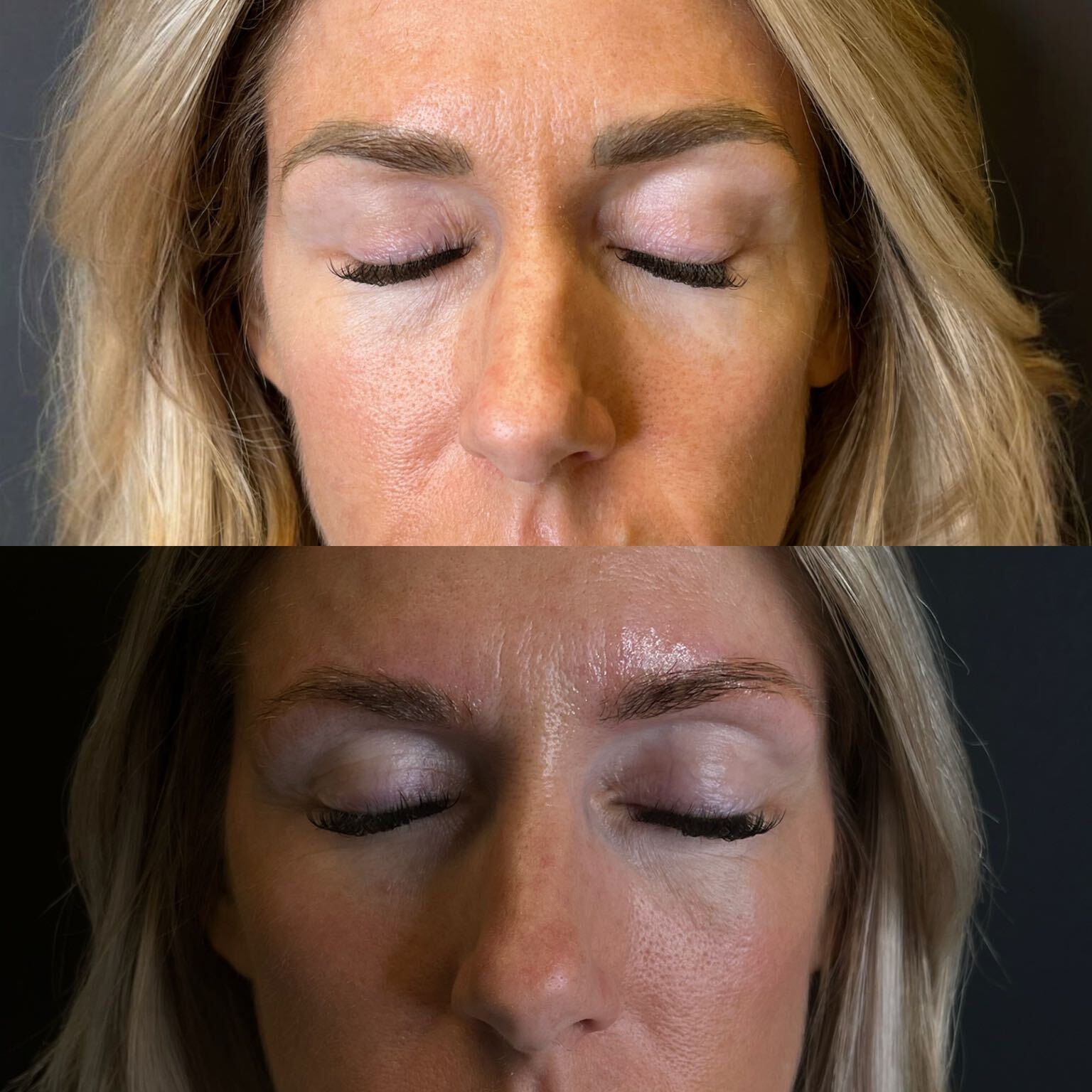 Microblading-removal progress, studio comparison 3