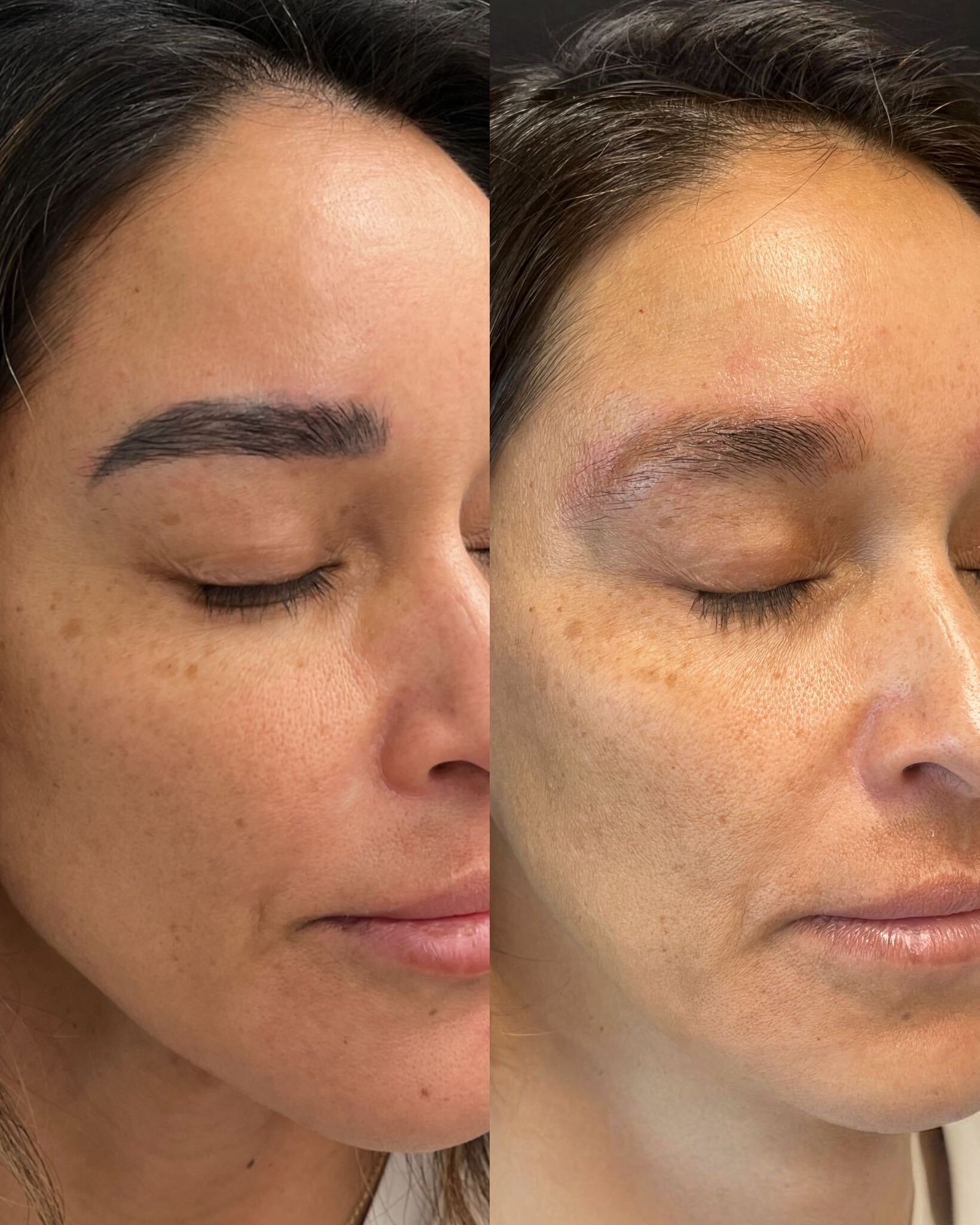 Microblading-removal progress, studio comparison 4