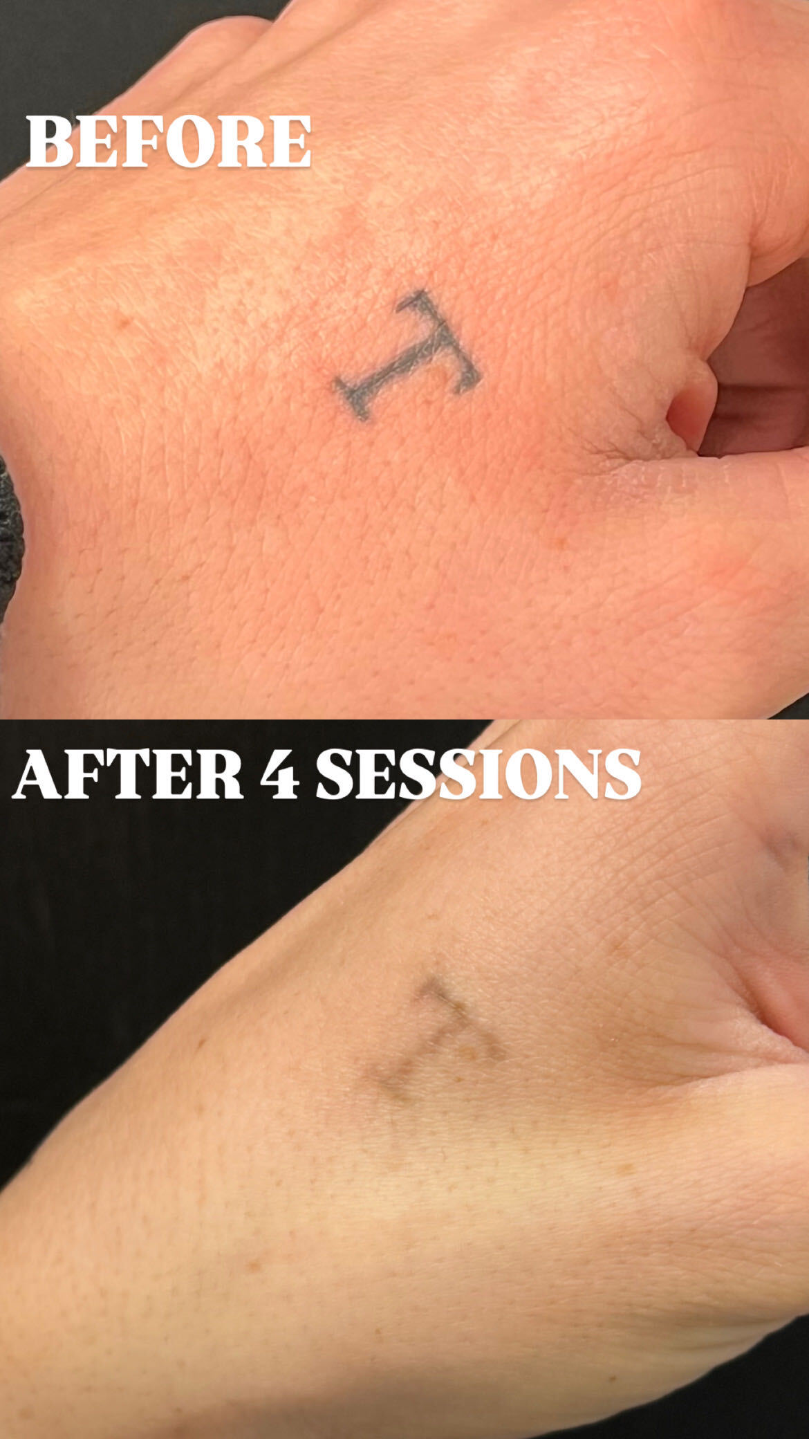 Tattoo-removal progress · after 4 sessions, studio comparison 1