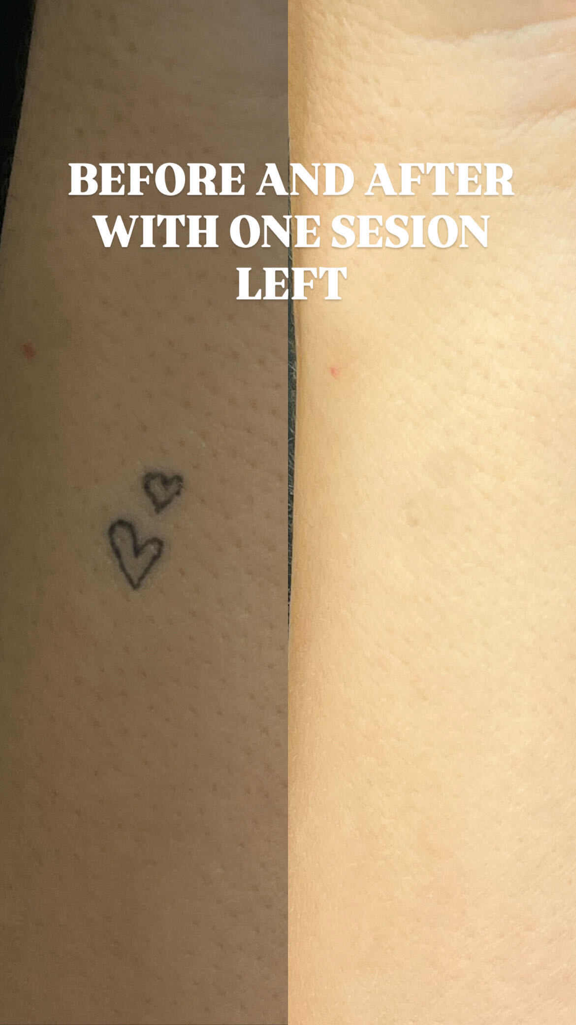 Tattoo-removal progress, studio comparison 2