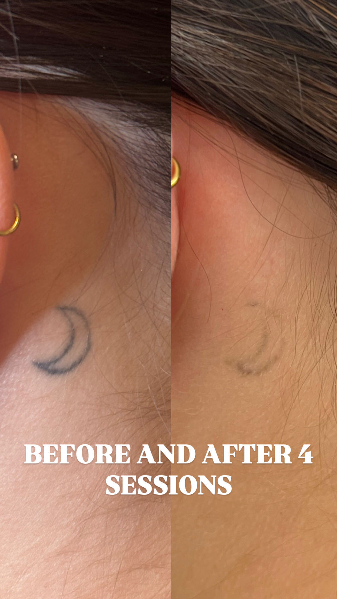 Tattoo-removal progress · after 4 sessions, studio comparison 3