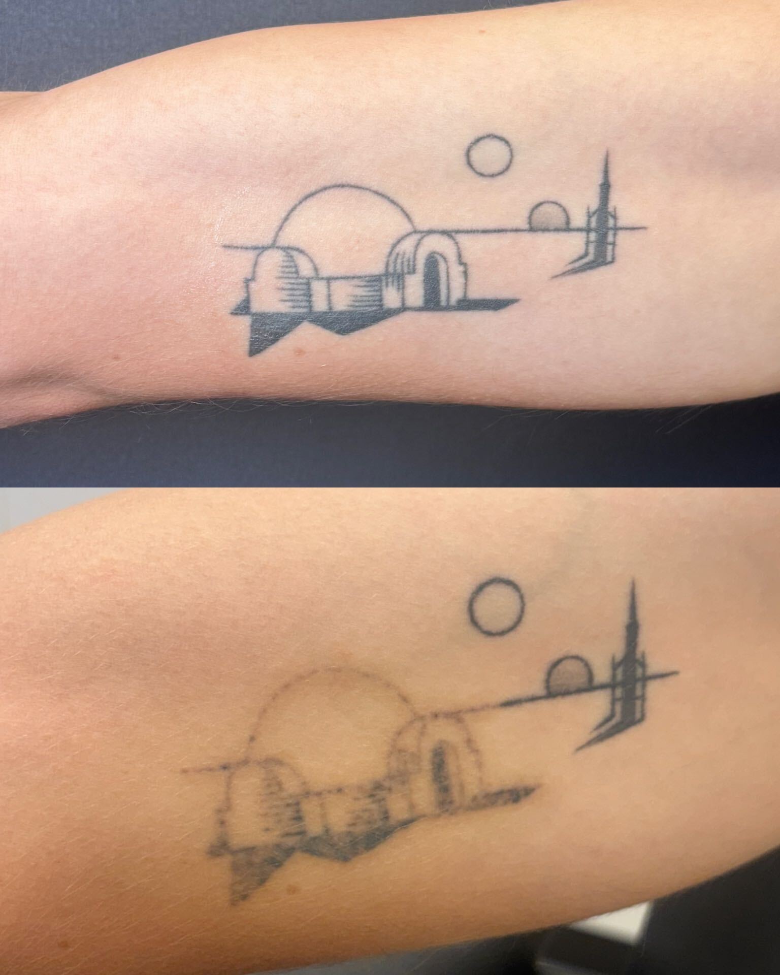 Tattoo-removal progress, studio comparison 4